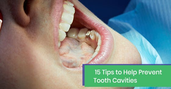 15 Tips to Help Prevent Tooth Cavities