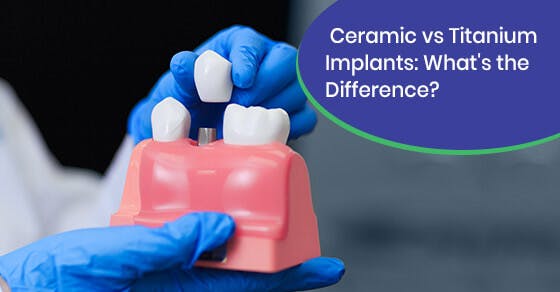 Ceramic vs Titanium Implants: What’s the Difference? Ceramic vs Titanium Implants: What’s the Difference?