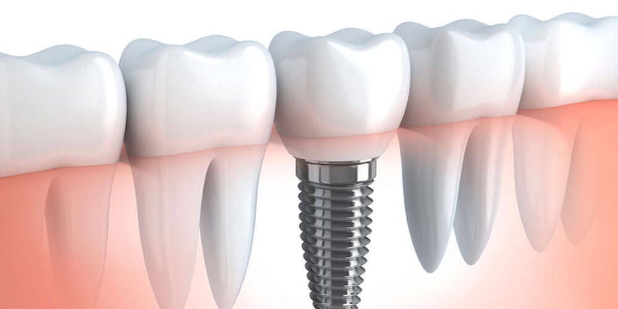Ceramic Dental Implants Edmonton